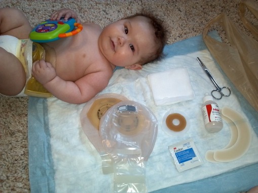 colostomy bag for baby